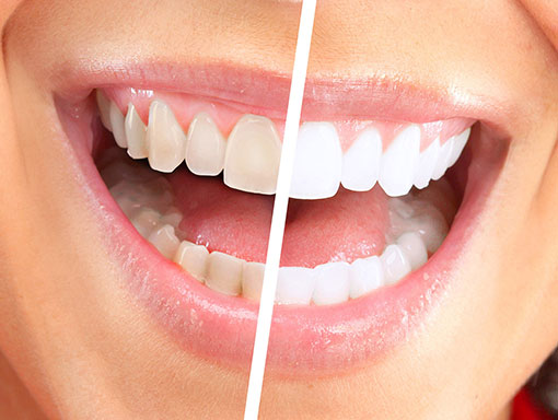 before and after teeth | Smiles Unlimited white teeth smiling