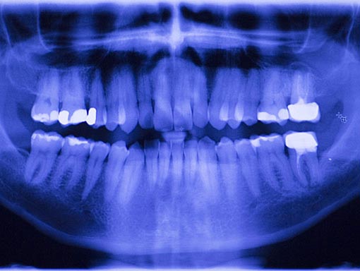 Dental X-Rays: Why Your Mouth Needs Them