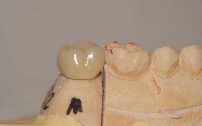 Dental Crowns