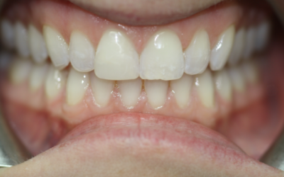 Satisfying Smiles – Veneers and Bonding