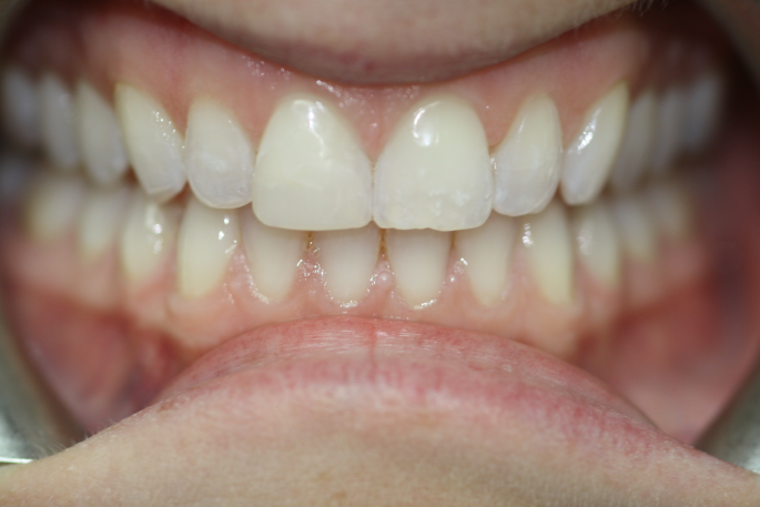 Satisfying Smiles – Veneers and Bonding