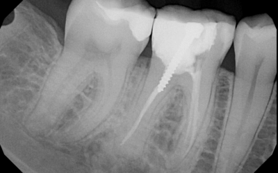Root Canals