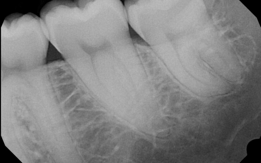 Wise Up On Wisdom Teeth