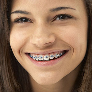 girl-with-braces-1 | Smiles Unlimited